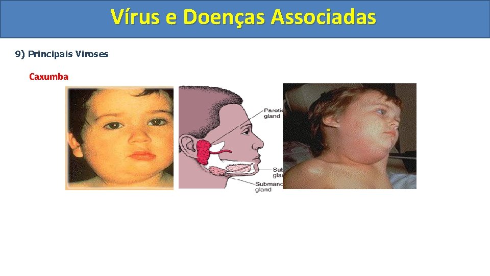 Vírus e Doenças Associadas 9) Principais Viroses Caxumba 