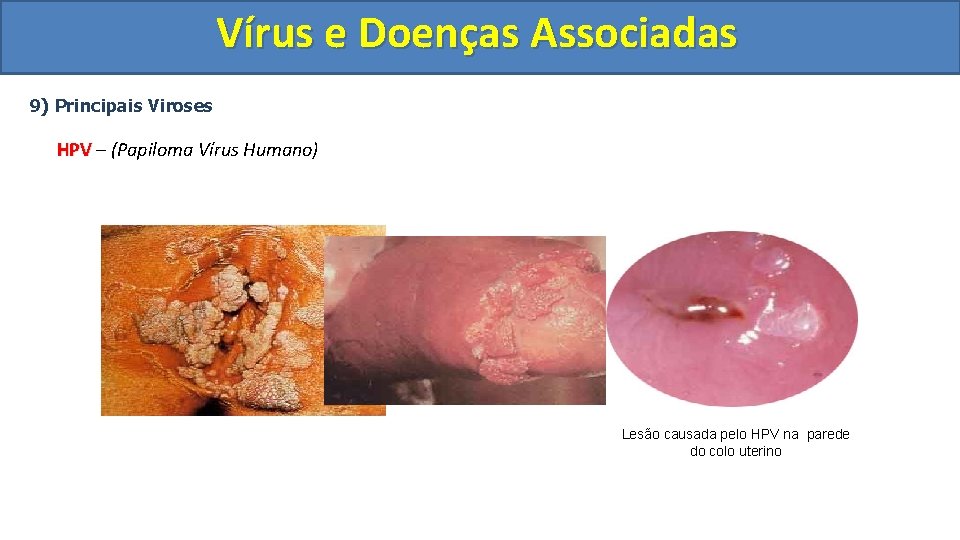 Vírus e Doenças Associadas 9) Principais Viroses HPV – (Papiloma Vírus Humano) Lesão causada