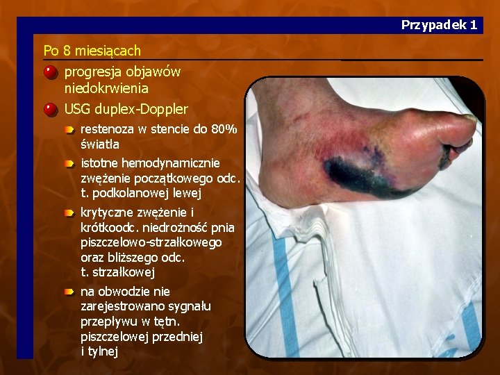 Przypadek 1 Po 8 miesiącach progresja objawów niedokrwienia USG duplex-Doppler restenoza w stencie do