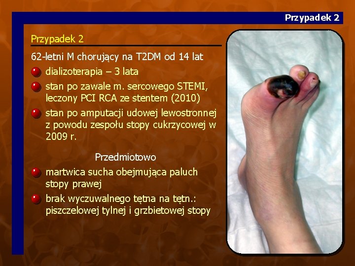 Przypadek 2 62 -letni M chorujący na T 2 DM od 14 lat dializoterapia