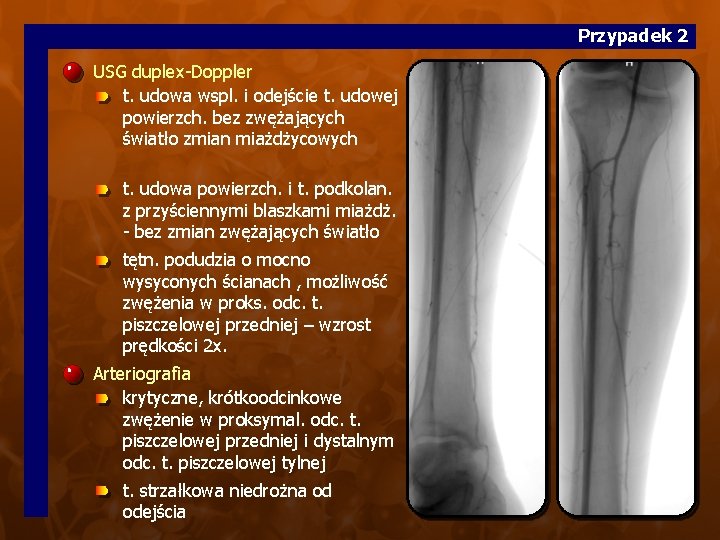 Przypadek 2 USG duplex-Doppler t. udowa wspl. i odejście t. udowej powierzch. bez zwężających