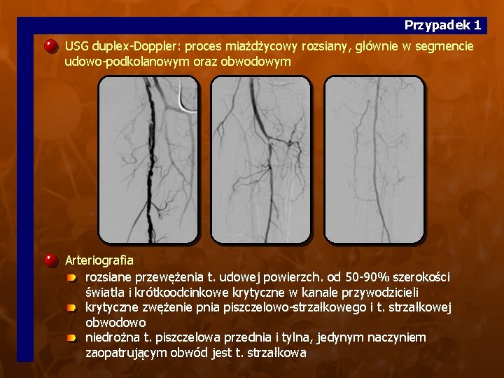 Przypadek 1 USG duplex-Doppler: proces miażdżycowy rozsiany, głównie w segmencie udowo-podkolanowym oraz obwodowym Arteriografia