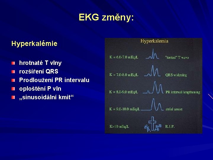 EKG změny: Hyperkalémie hrotnaté T vlny rozšíření QRS Prodloužení PR intervalu oploštění P vln