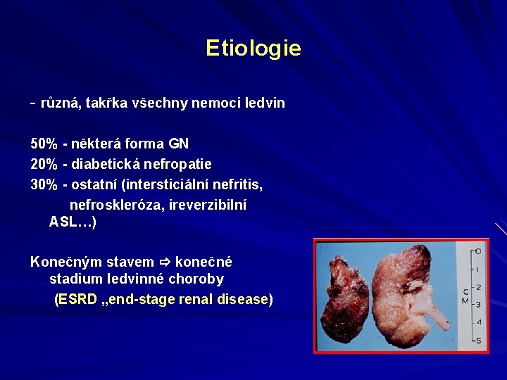 Etiologie - různá, takřka všechny nemoci ledvin 50% - některá forma GN 20% - Etiologie - různá, takřka všechny nemoci ledvin 50% - některá forma GN 20% -