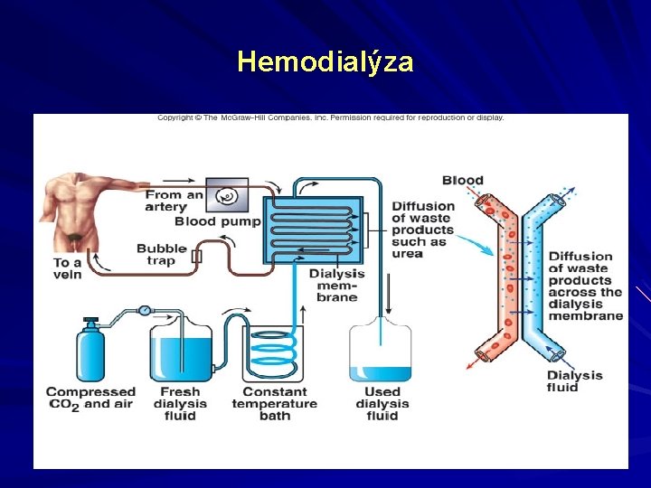 Hemodialýza 