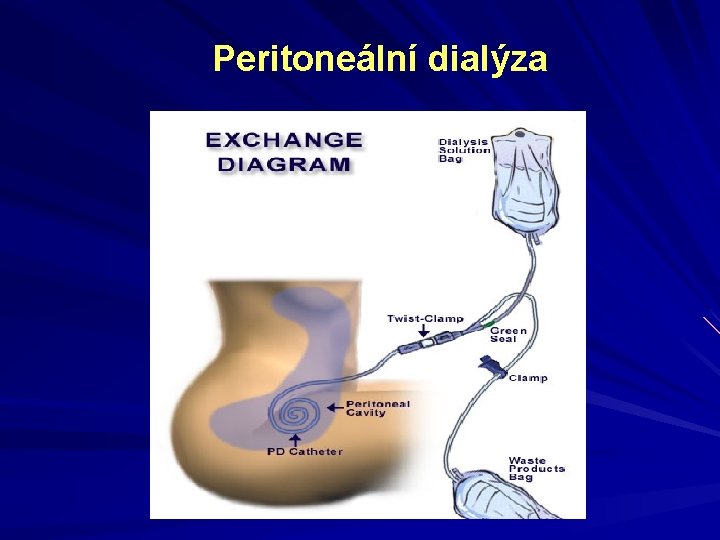 Peritoneální dialýza 