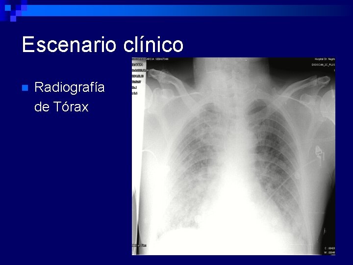 Escenario clínico n Radiografía de Tórax 
