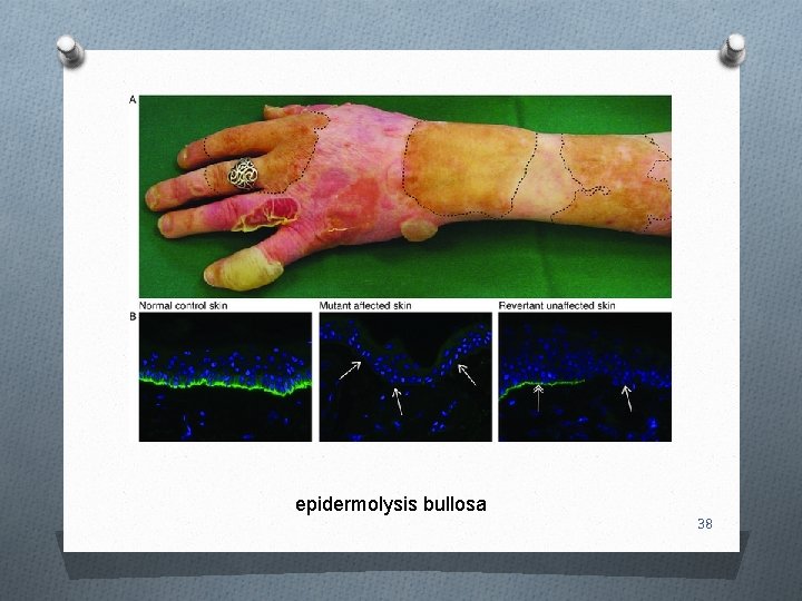 epidermolysis bullosa 38 
