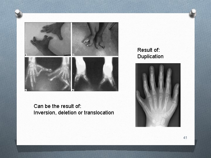 Result of: Duplication Can be the result of: Inversion, deletion or translocation 41 
