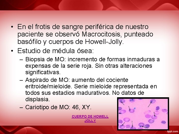  • En el frotis de sangre periférica de nuestro paciente se observó Macrocitosis,
