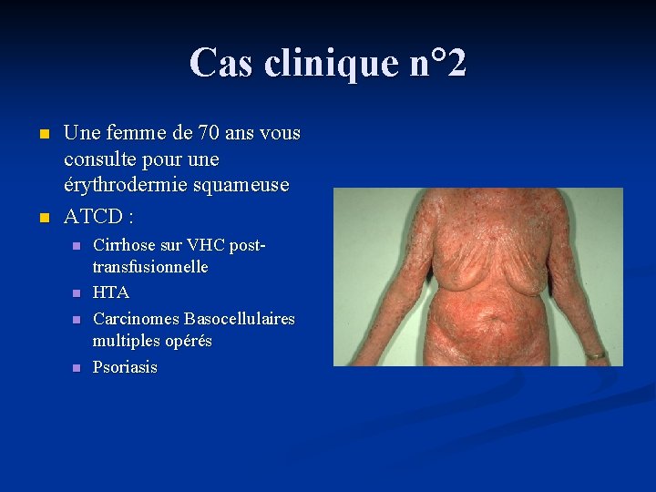 Cas clinique n° 2 n n Une femme de 70 ans vous consulte pour