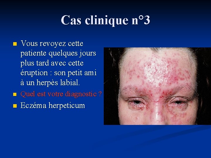 Cas clinique n° 3 n Vous revoyez cette patiente quelques jours plus tard avec