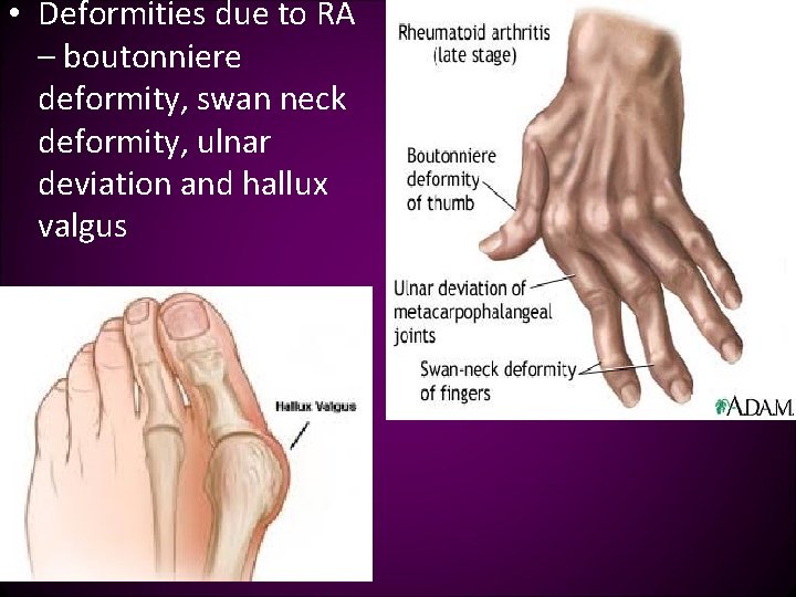  • Deformities due to RA – boutonniere deformity, swan neck deformity, ulnar deviation