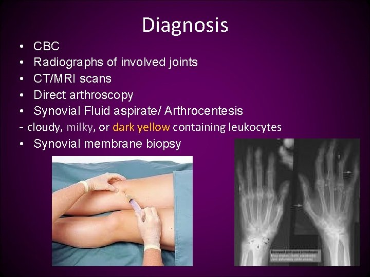 Diagnosis • CBC • Radiographs of involved joints • CT/MRI scans • Direct arthroscopy