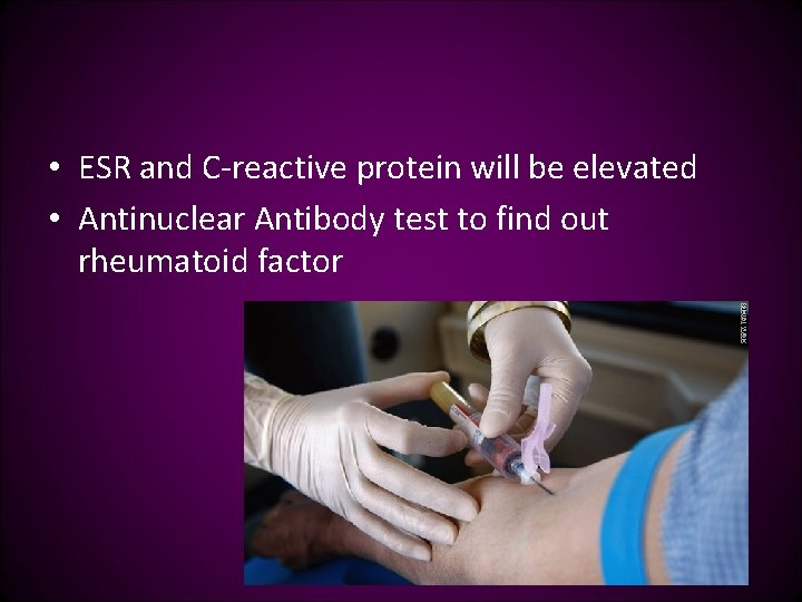  • ESR and C-reactive protein will be elevated • Antinuclear Antibody test to