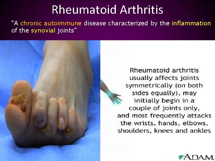 Rheumatoid Arthritis “A chronic autoimmune disease characterized by the inflammation of the synovial joints”