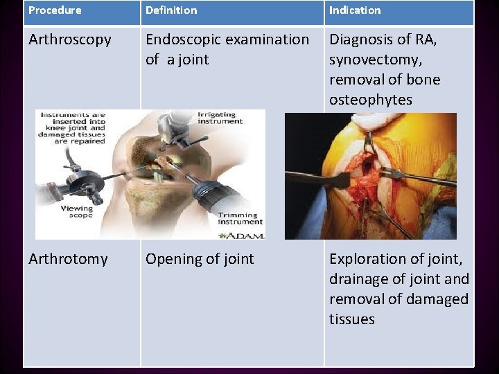 Procedure Definition Indication Arthroscopy Endoscopic examination of a joint Diagnosis of RA, synovectomy, removal