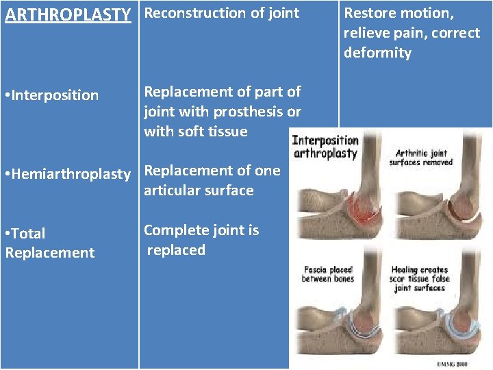 ARTHROPLASTY Reconstruction of joint • Interposition Replacement of part of joint with prosthesis or
