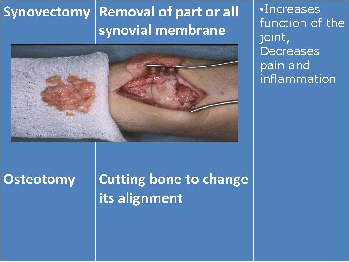 Synovectomy Removal of part or all synovial membrane Osteotomy Cutting bone to change its