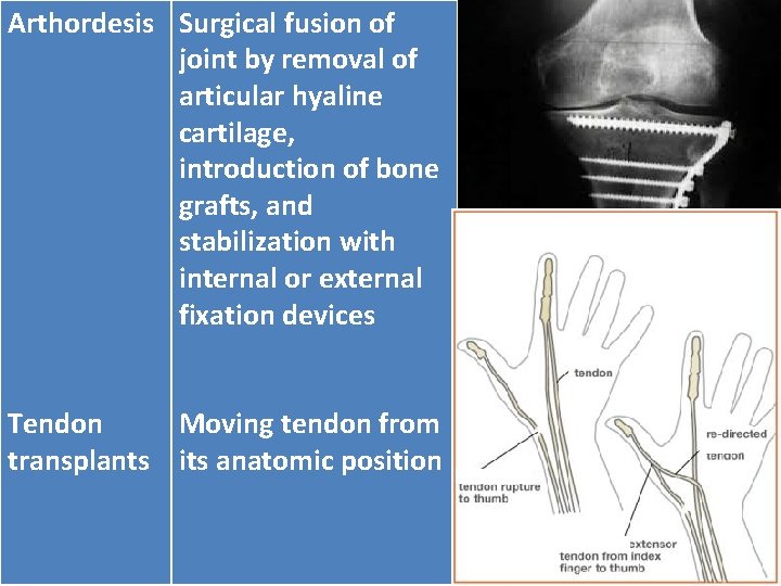 Arthordesis Surgical fusion of joint by removal of articular hyaline cartilage, introduction of bone