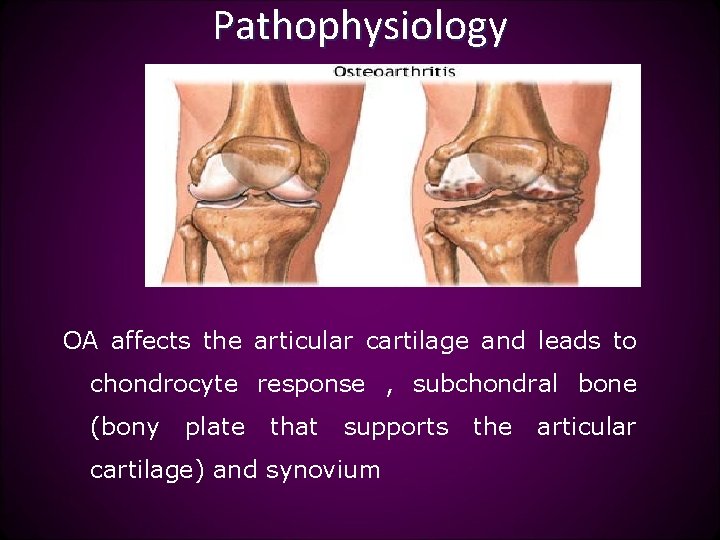 Pathophysiology OA affects the articular cartilage and leads to chondrocyte response , subchondral bone