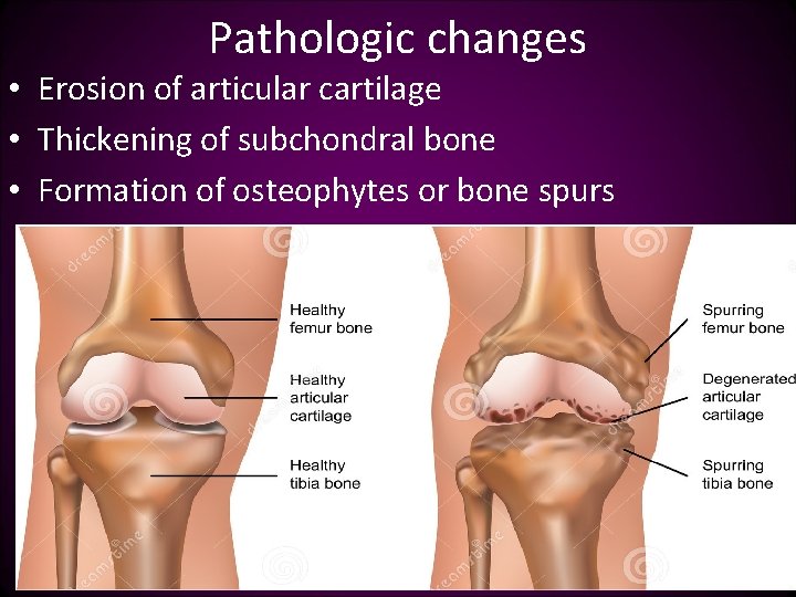 Pathologic changes • Erosion of articular cartilage • Thickening of subchondral bone • Formation