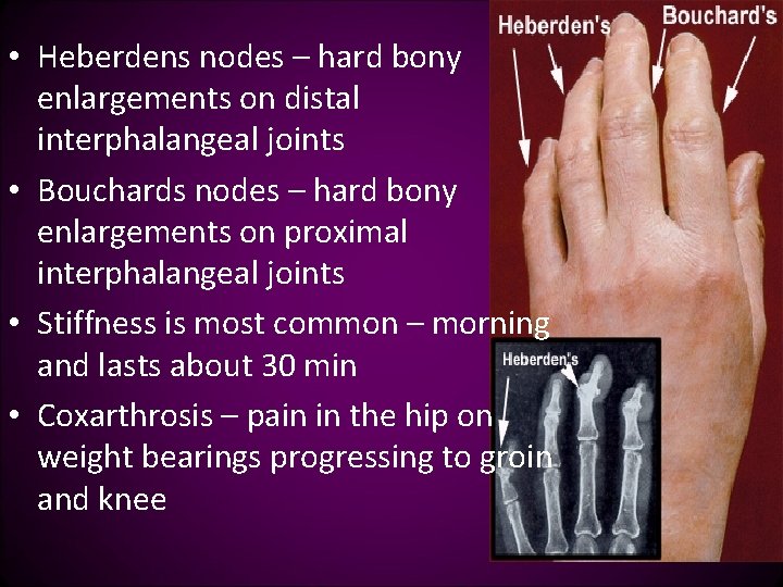  • Heberdens nodes – hard bony enlargements on distal interphalangeal joints • Bouchards