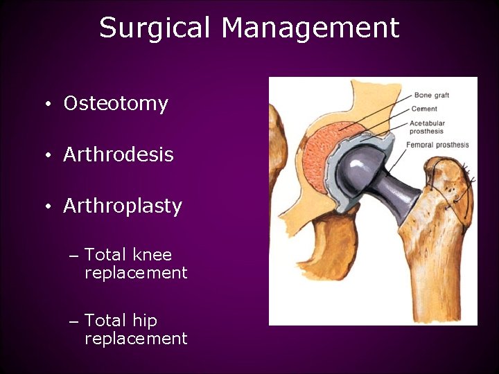 Surgical Management • Osteotomy • Arthrodesis • Arthroplasty – Total knee replacement – Total
