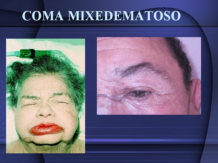 COMA MIXEDEMATOSO COMA MIXEDEMATOSO