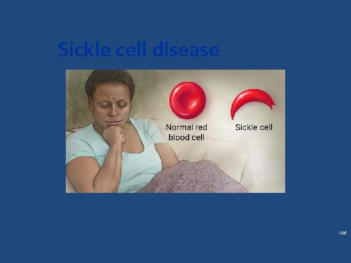 Sickle cell disease Ltd 