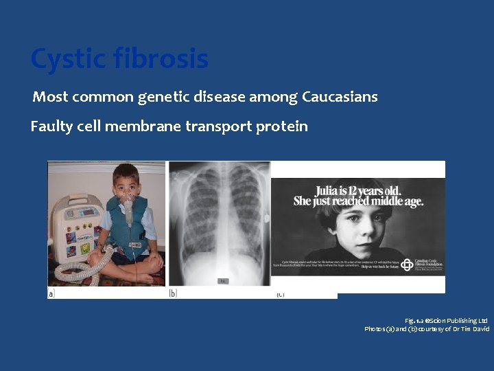 Cystic fibrosis Most common genetic disease among Caucasians Faulty cell membrane transport protein Fig.