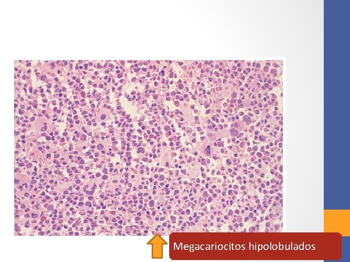 Megacariocitos hipolobulados 