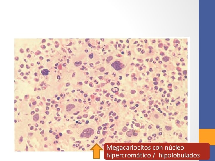 Megacariocitos con núcleo hipercromático / hipolobulados 