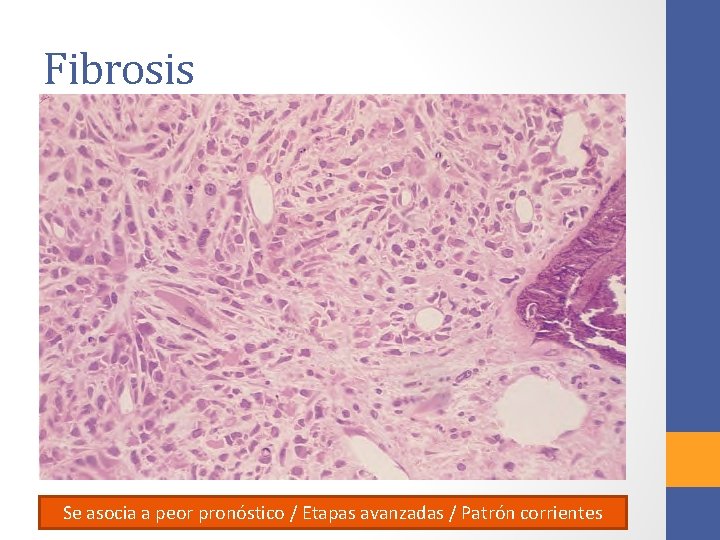 Fibrosis Se asocia a peor pronóstico / Etapas avanzadas / Patrón corrientes 