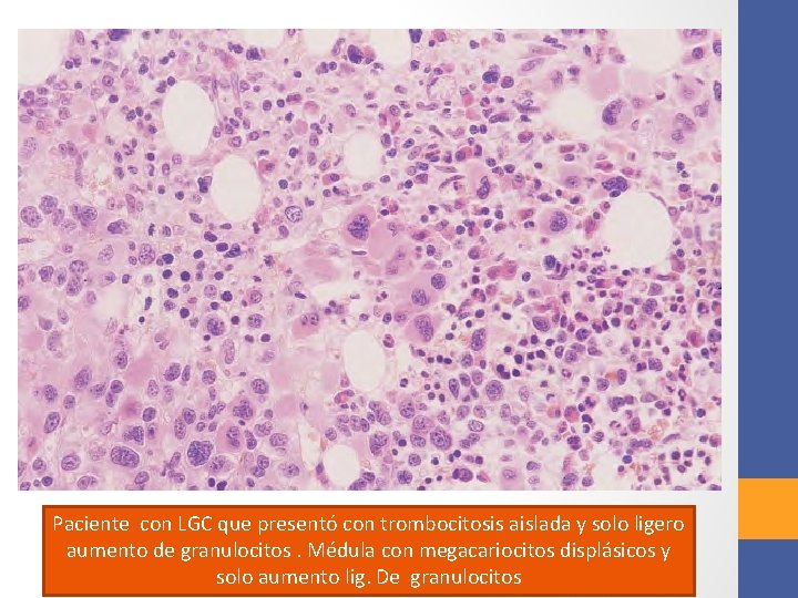 Paciente con LGC que presentó con trombocitosis aislada y solo ligero aumento de granulocitos.