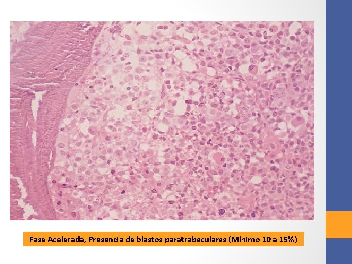 Fase Acelerada, Presencia de blastos paratrabeculares (Mínimo 10 a 15%) 
