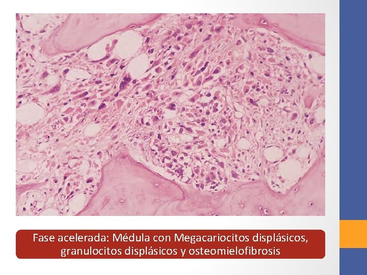 Fase acelerada: Médula con Megacariocitos displásicos, granulocitos displásicos y osteomielofibrosis 
