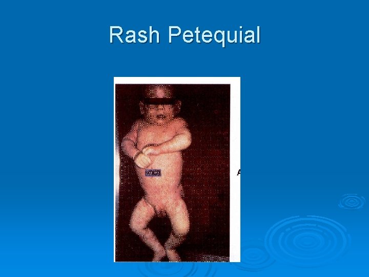 Rash Petequial Rash Petequial