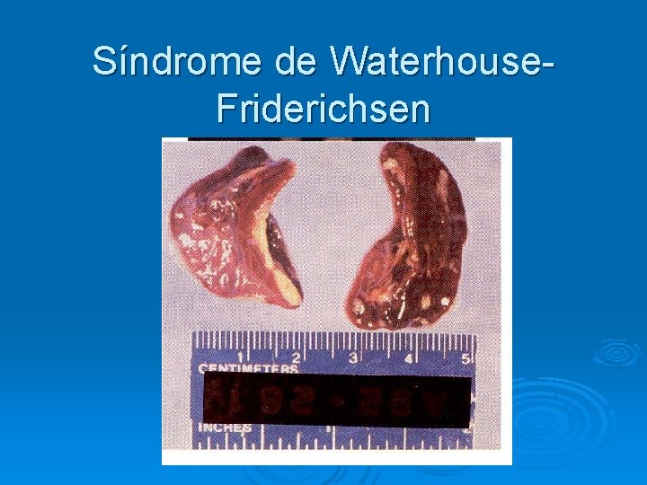 Síndrome de Waterhouse. Friderichsen Síndrome de Waterhouse. Friderichsen