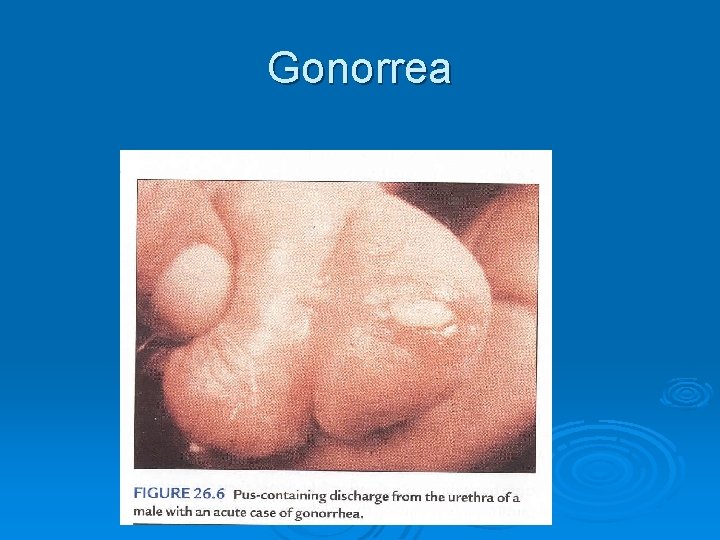 Gonorrea Gonorrea