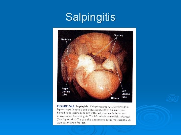 Salpingitis Salpingitis