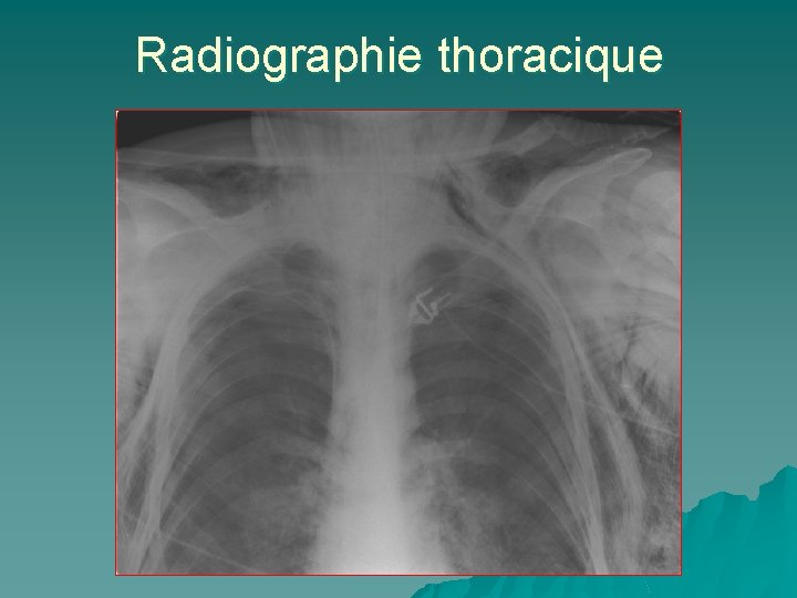 Radiographie thoracique 