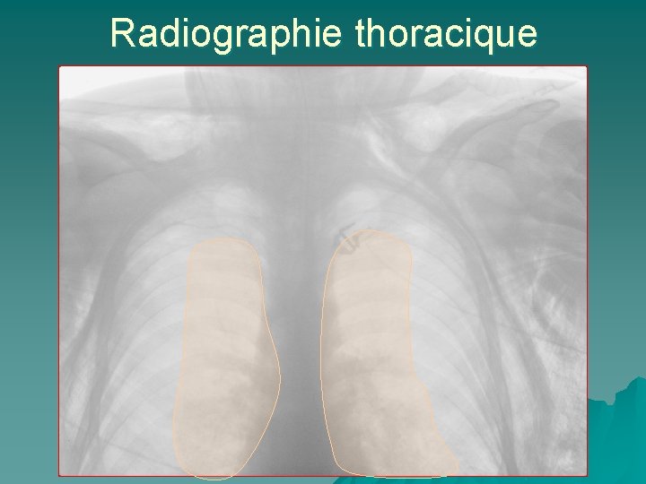 Radiographie thoracique 