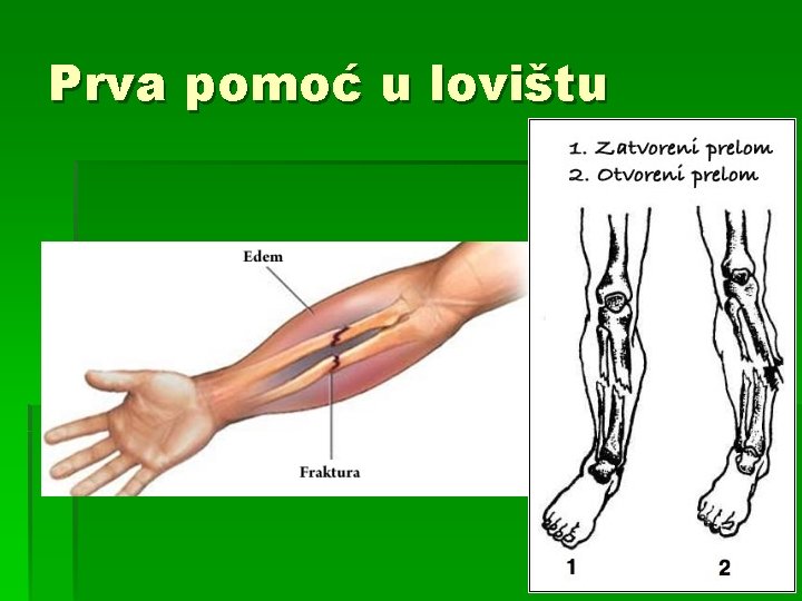 Prva pomoć u lovištu 