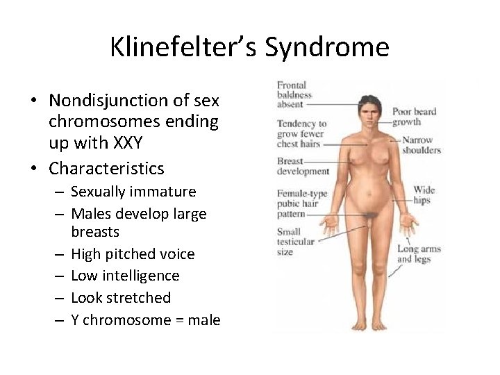 Klinefelter’s Syndrome • Nondisjunction of sex chromosomes ending up with XXY • Characteristics –