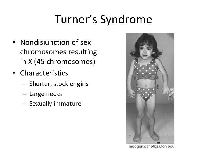 Turner’s Syndrome • Nondisjunction of sex chromosomes resulting in X (45 chromosomes) • Characteristics