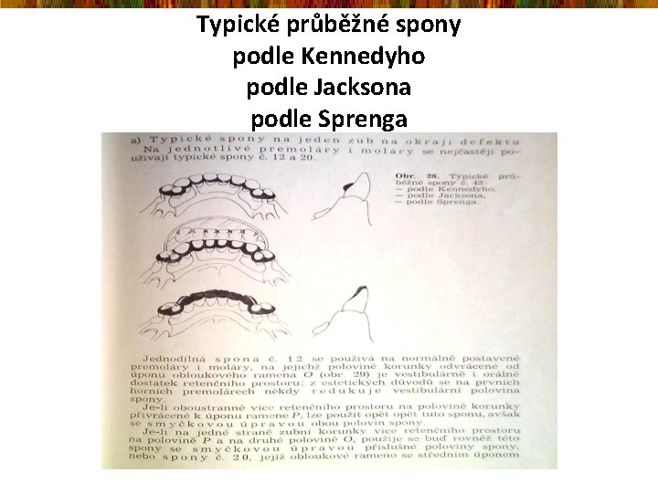 Typické průběžné spony podle Kennedyho podle Jacksona podle Sprenga 