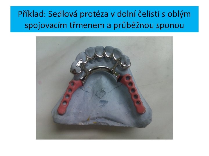 Příklad: Sedlová protéza v dolní čelisti s oblým spojovacím třmenem a průběžnou sponou 