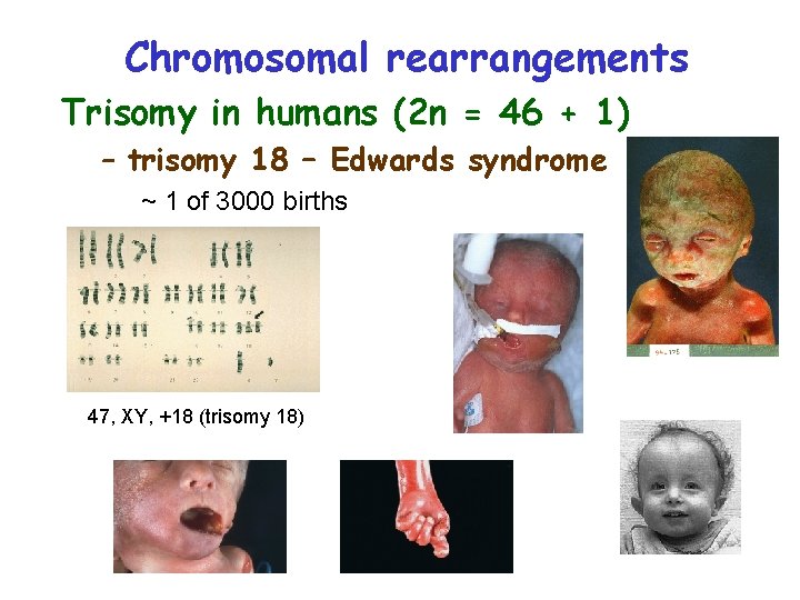 Chromosomal rearrangements Trisomy in humans (2 n = 46 + 1) – trisomy 18