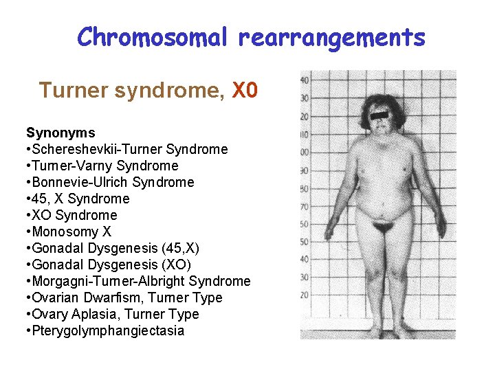 Chromosomal rearrangements Turner syndrome, X 0 Synonyms • Schereshevkii-Turner Syndrome • Turner-Varny Syndrome •